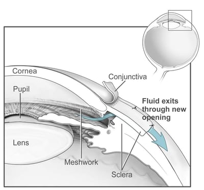 Conventional_surgery_to_treat_glaucoma_EDA11.jpg